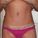 front view of tummy scar