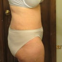 Right Side 4 weeks
