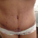 TT 18 days PO; drains came out the day before; scabbing around incision is because I had an allergic reaction and blistering to the surgical tape placed after surgery.
