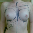 Before Breast Augmentation 2007