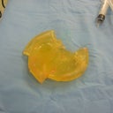 Right Implant