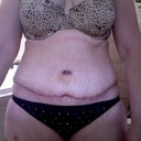 Day 5 and looking much better. Still pretty swollen.
