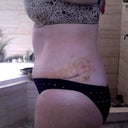 Day 5 and looking much better. Still pretty swollen.