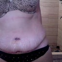 Day 5 and looking much better. Still pretty swollen.