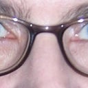 My eyes jut before the Restylane.  It is a picture with glasses, so it's not the best  for comparison.