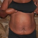 This is my before-- two days prior to my procedure, which is scheduled for 10/26/2012
Frontview