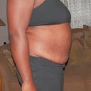 This is my before-- two days prior to my procedure, which is scheduled for 10/26/2012
Sideview