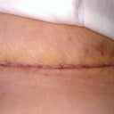 after my shower Day 6 close up of my scar