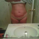 before my surgery1
