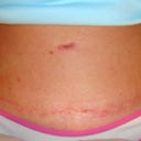 This is my scar at 8 weeks.