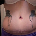 I am a little swollen in this one at 2 months out. I still have to watch the sodium levels to help the water retention some days. I'm using a silicone scar sheet.