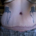 Also about 2 months out, give or take a week. Not swollen this day. My belly button is scarred badly and I'm just hoping it gets better.