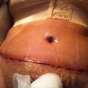 2 days post op, just found these