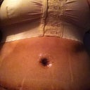 2 days post op
