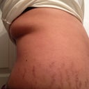 back rolls will be lipoed as well!