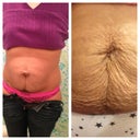 Before my hernia was removed and after it was removed. You can see the lump on my belly button that was the hernia and now I actually have a belly button hole underneath my bad skin. Looking forward for Dra. Robles to fix my tummy and make me back how I was before my kids.