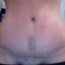 3 weeks po. Scar up close...has tape on it though. But it really is light and teeny!!