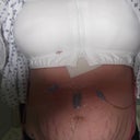 Right after surgery..