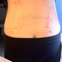 Back post surgery 12 hours