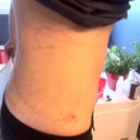 Incision site is so small.  Post surgery 12 hours