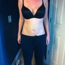 Day 2 post surgery 24 hours.  Never have had this flat of tummy!!