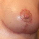 this is a close up on the nipple scars.  They are starting to disolve and spread out alittle. They are a tad itchy too.  That should go away too.  It's an unattractive stage, but I guess it's normal.