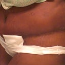 3 wks side lipo