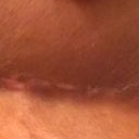 close up of incision at 3 wks