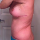 6 months post op - side view