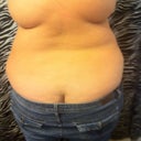 Back to show bra line area that will be lipo