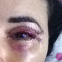 Incision lines flared up to eyebrows.  Incisions well above the natural crease of eyes. Scars still evident today.