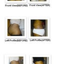 Liposuction abdomen