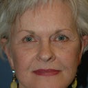 Brow Lift And Face Lift