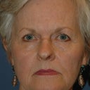 Brow Lift And Face Lift