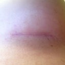 Incision day 20, they both look the same. So happy about how they look. Hopefully in few months I will barely will be able to see them ;-)