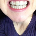 Up close with Invisalign in. After set 4 of 16.