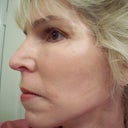 6 weeks after surgery