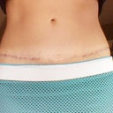 After final scar revision.