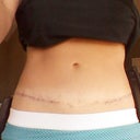 Final scar revision.