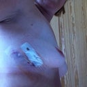 AFTER EXPLANT - RIGHT SIDE VIEW