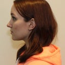 After - profile view, left
