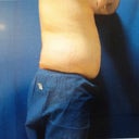 Pre-Surgery
