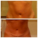 The day of touch up lipo, 2 weeks post op