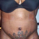 only 10days post operative