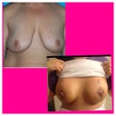 5 days PO before and after