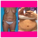 5 days PO before and after