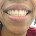 After 20 weeks/10 trays top and bottom.  What do you think??