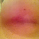 incision on the left at two weeks