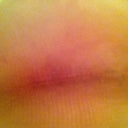 incision on the right at two weeks