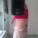 5 days post op